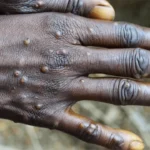 Mpox (anciennement variole du singe)